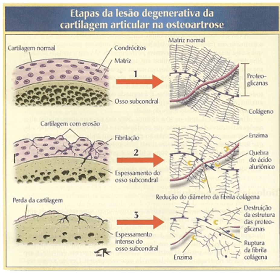 fisiopatologia-da-osteoartrose