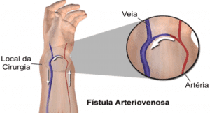 fístula arteiovenosa em região radial.