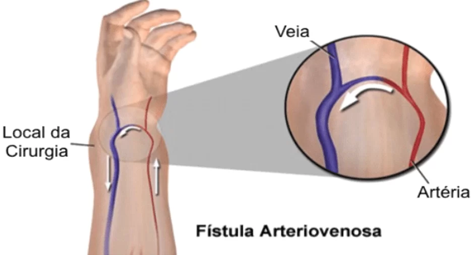 arteiovenosa fístula en región radial.