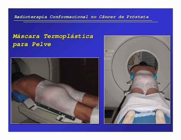 Figura 1 - Representação do tratamento radioterápico em Teleterapia em especifico ao câncer de próstata