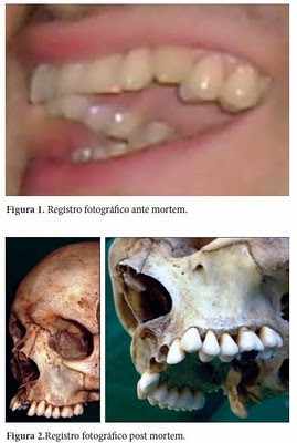 Figura 2 - Identificação humana em odontologia legal por meio de registro fotográfico 