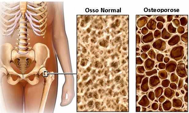 FIGURA 2: Verificação da calcificação óssea.