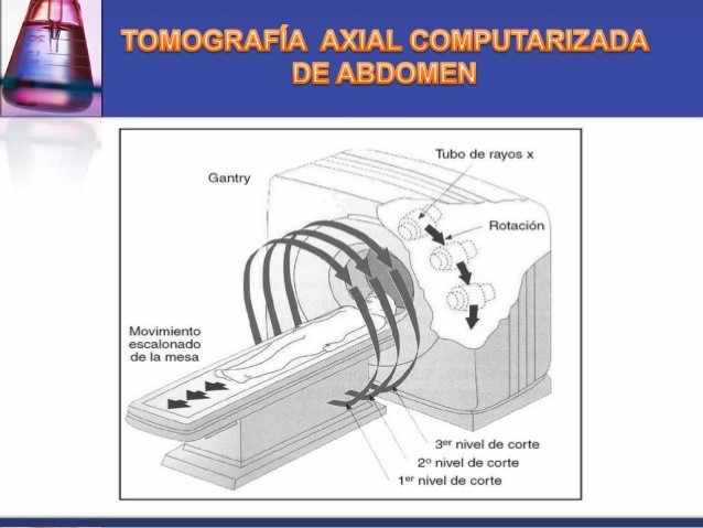 Figura 2 - Paciente é movido através do pórtico, para fora e para dentro, enquanto ocorre a rotação do tubo de raios X e o detector descreve uma trajetória helicoidal ou espiral sobre o paciente, adquirindo dados para a imagem com sua rotação.