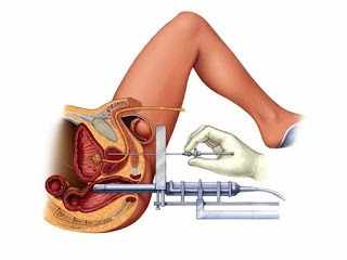 Figura 3 - Utilização da fonte de cobalto aplicado na próstata na modalidade de braquiteraria