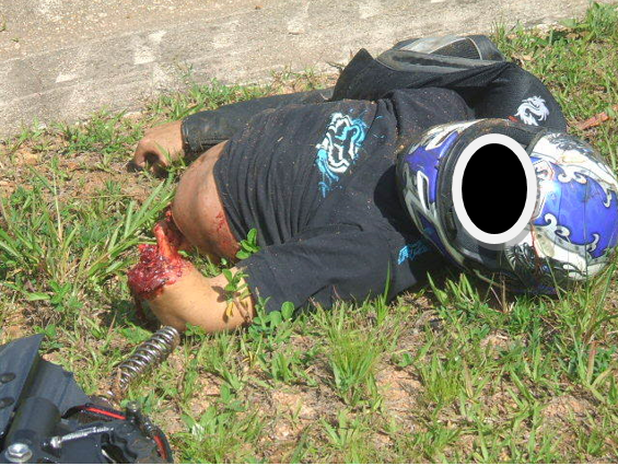 Acidente fatal envolvendo motociclista e defensa metálica, com dilaceração de membros superiores e inferiores do tronco, mediante choque. Fonte: http://www.falcononline.com.br/forum/index.php?topic=3032.45no-vale-verde/