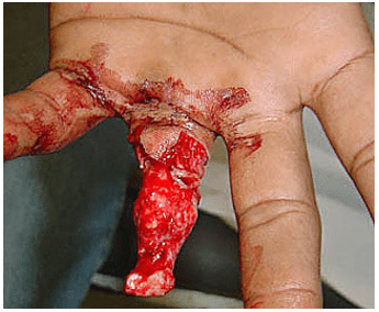 Foto 02 – Perda do dedo por uso inadequado de ganchos em traves de futebol. Fonte das fotos 01 e 02: http://mortehumana.blogspot.com.br/2008/08/dedo-reemplantado.html