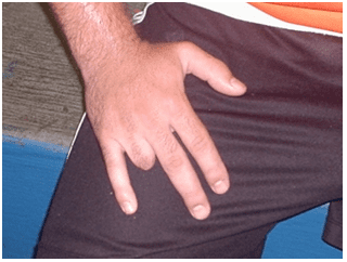 Foto 3 – Resultado da perda de dedo mediante acidente com ganchos metálicos na trave. Foto: Do Autor, conforme pesquisa em quadras esportivas