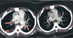 Figura 2 – A) Angiotomografia de tórax com injeção de contraste, evidenciando tromboembolismo pulmonar e derrame pleural à direita. B) – Tomografia Computadorizada de controle pós trombólise mostra dissolução parcial dos trombos presentes nas artérias pulmonares, redução do calibre das artérias pulmonares e resolução completa do derrame pleural. FONTE: Prontuário clínico. 2016.
