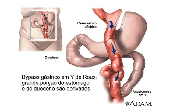 Figura 1 - Técnica Bypass gástrico em Y de Roux (BGYR). Fonte:  https://fizcirurgiabariatrica.wordpress.com/2010/09/22/32%C2%BA-dia-apos-a-cirurgia-bariatrica-ou-gastroplastia