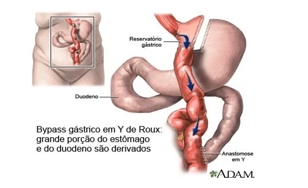 Figura 1 - Técnica Bypass gástrico em Y de Roux (BGYR). Fonte: https://fizcirurgiabariatrica.wordpress.com/2010/09/22/32%C2%BA-dia-apos-a-cirurgia-bariatrica-ou-gastroplastia