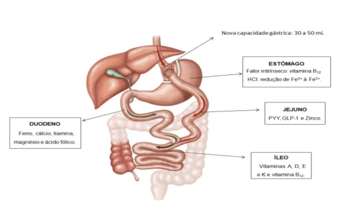 Figura 2 - bypass gástrico em Y-de-Roux (BGYR) e nos quadrados menores as principais alterações nutricionais. Fonte: Lívia A. BORDALO et al. Deficiências nutricionais após cirurgia bariátrica, 2011.