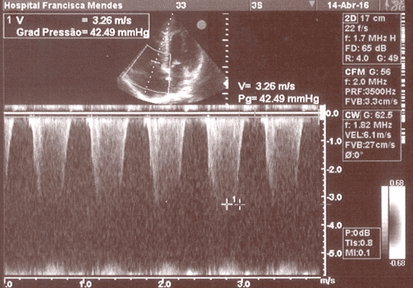 Figura 2 – Ecocardiograma evidencia a valva tricúspide com dilatação do anel e apresentando insuficiência moderada. PSAP estimada em 62mmHg. (14/04/16)