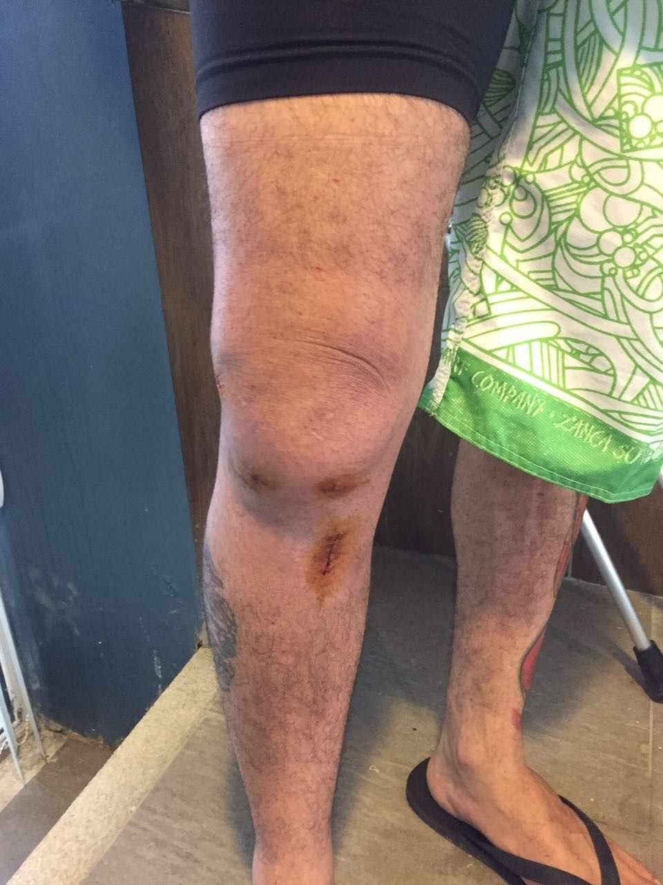 Figure 1: knee injury on the first day, evidencing the edema/research data.
