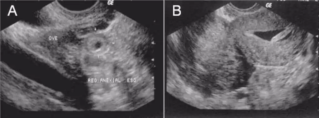 Figura 1 - Aspectos ultrassonográficos de gravidez ectópica. A: Sinal do anel tubário (saco gestacional no anexo). B: Massa anexial. Fonte: Rios (2010).