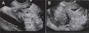 Figura 1 - Aspectos ultrassonográficos de gravidez ectópica. A: Sinal do anel tubário (saco gestacional no anexo). B: Massa anexial. Fonte: Rios (2010).