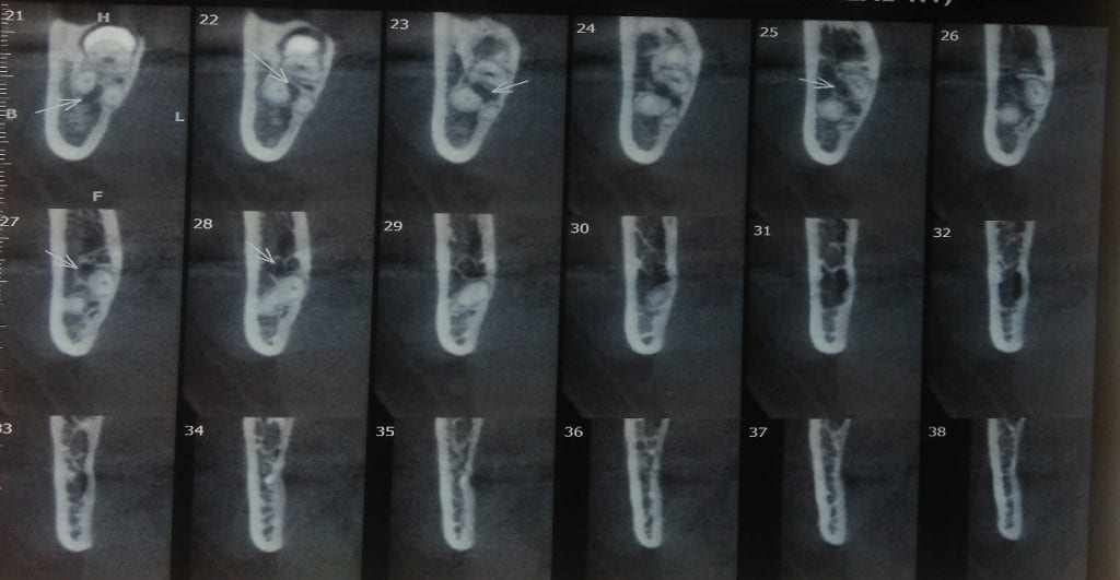 Figura 1: TC da relação do NAI com as raízes do terceiro molar inferior com corte coronal. Fonte: Próprio Autor