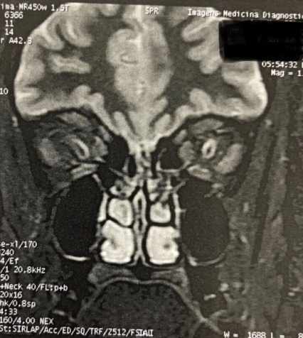 C:\Users\Caio\Desktop\OTORRINOLARINGOLOGIA\fistulas rinogenicas\e611ec16-1944-4f2f-a44f-e9f1e9b69b4b.jpg