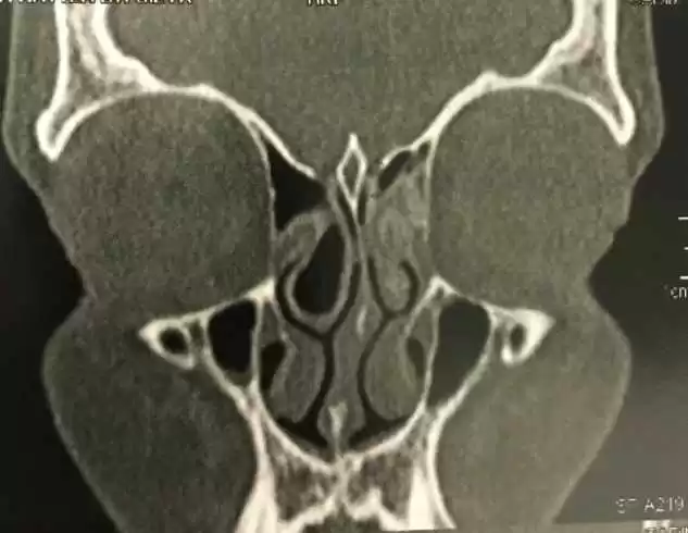 C:\Users\Caio\Desktop\OTORRINOLARINGOLOGIA\fistulas rinogenicas\IMG_4037.jpg