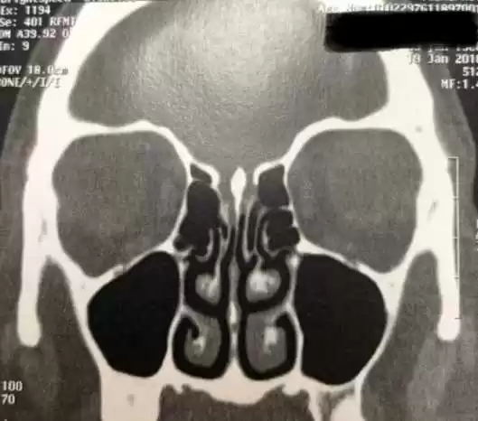 C:\Users\Caio\Desktop\OTORRINOLARINGOLOGIA\fistulas rinogenicas\a994cf8a-a107-4152-abfe-f3b6222a6833.jpg