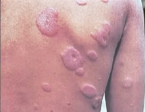 Hanseníase: as causas, sintomas e tratamentos da doença de pele