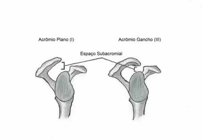 Tipo acromial de brasileiros Estudo em escápulas humanas Tipo acromial de brasileiros Estudo em escápulas humanas