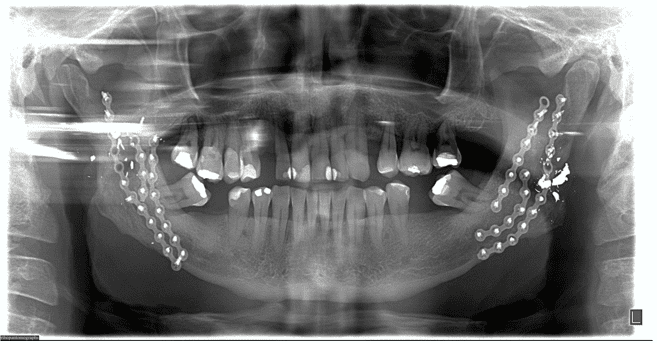 TRATAMENTO PARA Fratura Mandibular