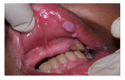hpv related tongue cancer)