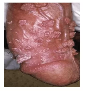 Cancer hpv homme - Hpv homme porteur sain, Papillomavirus porteur sain - genunetwork.ro