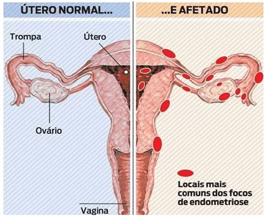 Endometriose - o que causa no corpo?