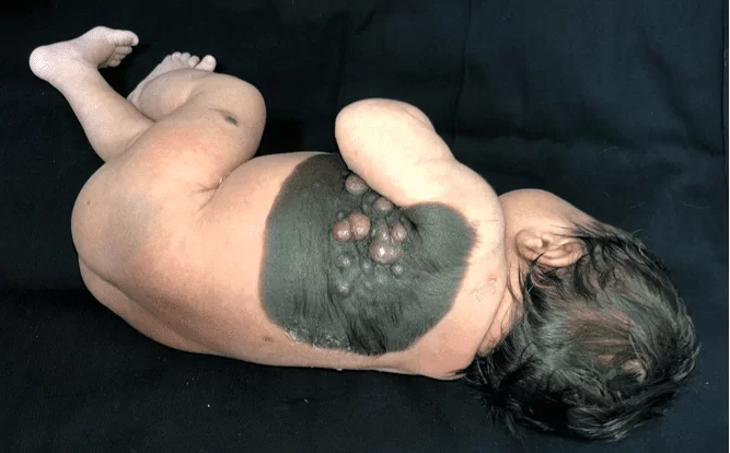 Nevo melanocítico congênito gigante placa enegrecida, de superfície aveludada, bem delimitada, pilosa, com tumorações centrais, com mais de 20 cm