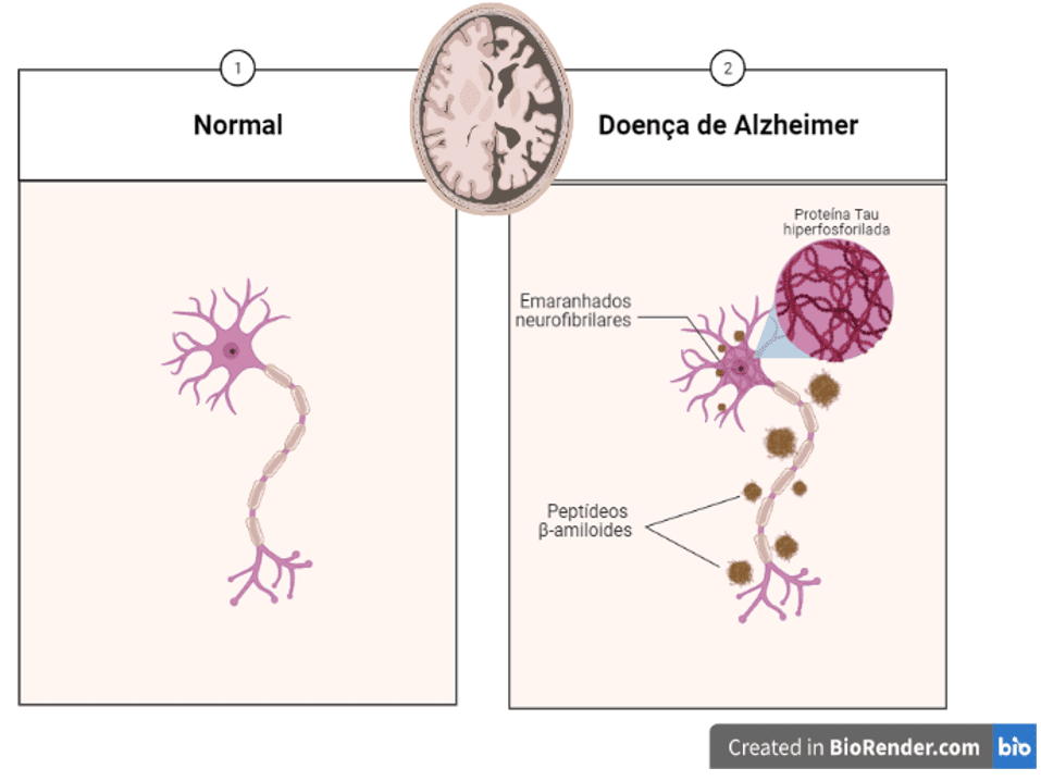 Diferença entre um neurônio saudável e um neurônio na DA.