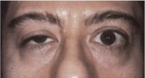 ptose palpebral