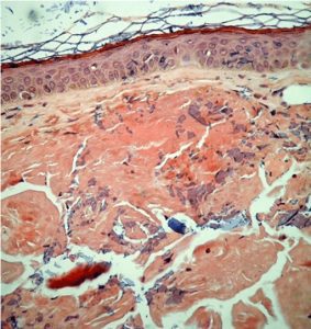 Depósitos de material amiloide na derme, corados em róseo pelo Vermelho-congo (aumento original de 200X)