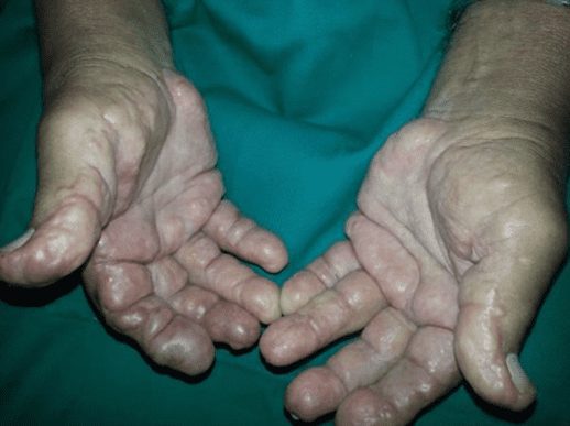 Nódulos infiltrados normocrômicos na borda lateral e flexora dos dedos das mãos e palmas