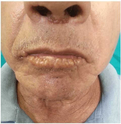 Pápulas amareladas, endurecidas, confluentes, dispostas linearmente na região perilabial inferior e na base de inserção do septo nasal