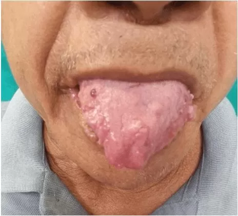 Pápulas normocrômicas na língua e mucosa oral e macroglossia