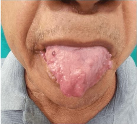 Pápulas normocrômicas na língua e mucosa oral e macroglossia
