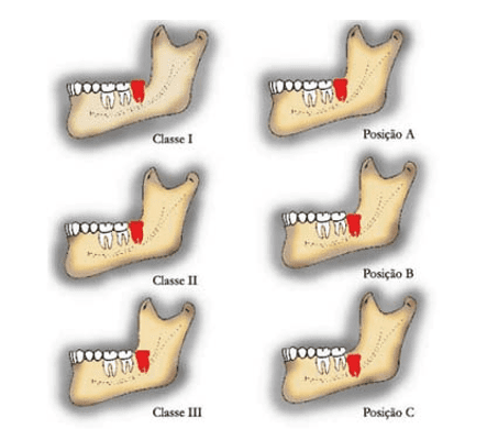 Classificação da posição dos terceiros molares segundo Pell e Gregory.