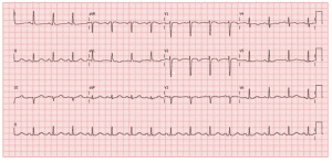 ECG pós-trombólise
