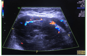 Ultrassonografia da mama direita apresentando massa sólida hipervascularizada ao estudo com Doppler, medindo aproximadamente 5,52 x 3,43 cm.