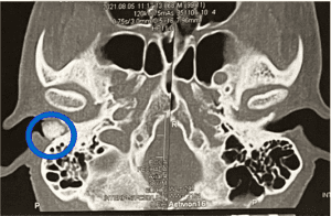 Visualização de osteoma de conduto interno em ouvido direito, com cerca de 1 cm, em tomografia computadorizada.