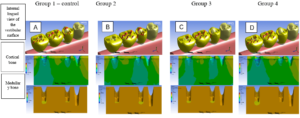 Results of experimental groups for stresses in cortical and medullary bones (internal lingual view of the vestibular surface