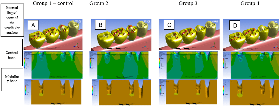 Results of experimental groups for stresses in cortical and medullary bones (internal lingual view of the vestibular surface