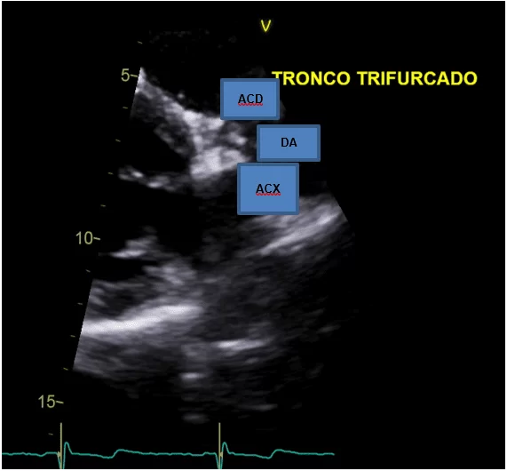 Trajeto anômalo da CD, procedente do tronco da artéria coronária esquerda (ACE) que é trifurcado origem da CD, Circunflexa (ACX) e Descendente anterior (DA).