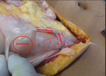 pêndice vermiforme em posição retrocecal.