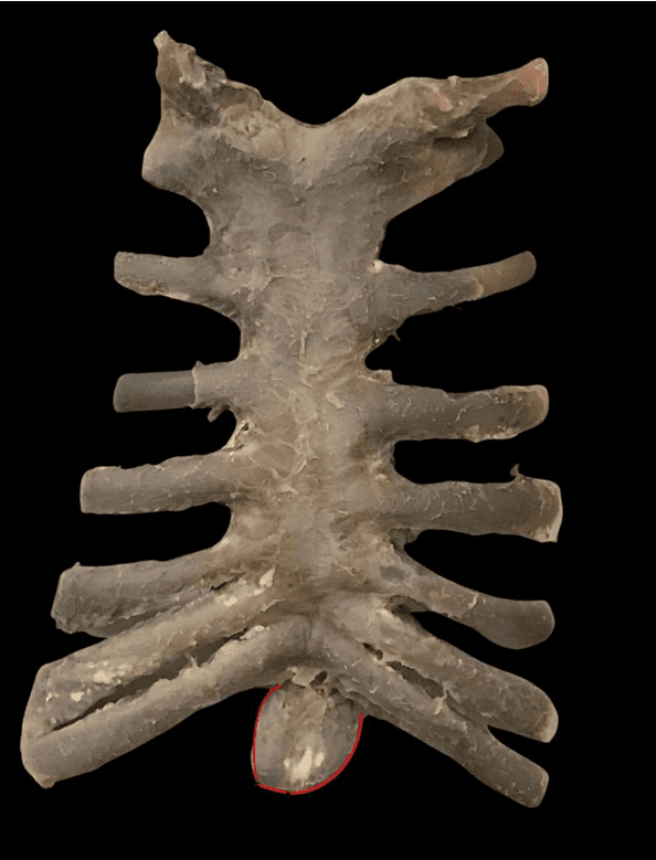 Ventral view of the sternum display a concaveness and angulation of the sternum of the sternum