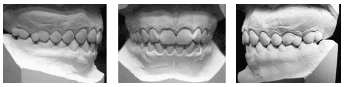 PDF ) Estudo das alterações dento-esqueléticas decorrentes do tratamento da  má oclusão de classe II, 1ª divisão, com o aparelho propulsor mandibular  twin force bite corrector, associado à aparelhagem fixa