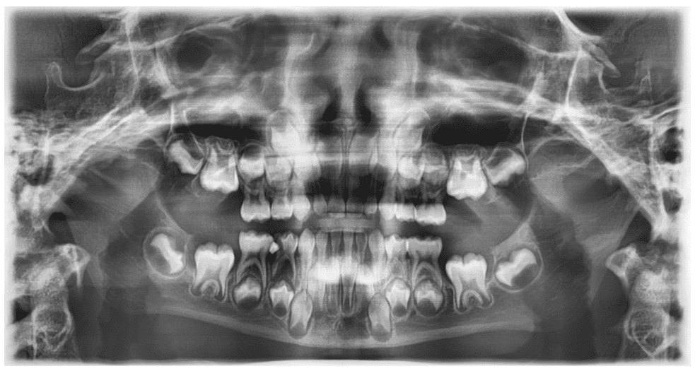BK mostra radiografia de consumidores que deslocaram a mandíbula