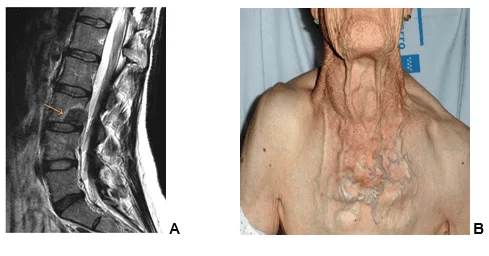 Figura 1 - (A) Ressonância Magnética da coluna lombar evidenciando Metástase no corpo da vértebra.  (B) Ilustrando paciente com a SVCS.