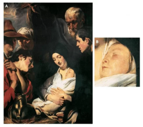 Figure 2 - peinture "Adoration du Berger," Jacob Jordaens - Anvers, Belgique. Source: Déplacer vers le bas. Disponible à l'adresse: accès <http://www.movimentodown.org.br/2015/05/sindrome-de-down-na-historia-parte-03 srcset=
